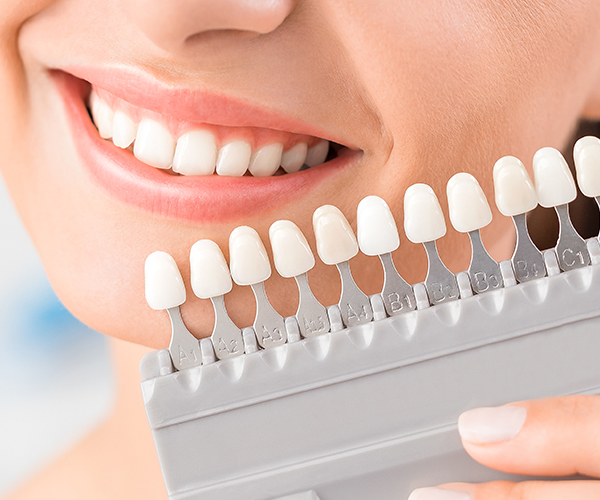 Bleaching Trays in Southend, Essex at Stibbards