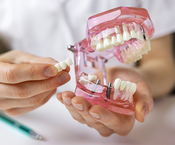 Implant Retained Dentures in Southend, Essex at Stibbards